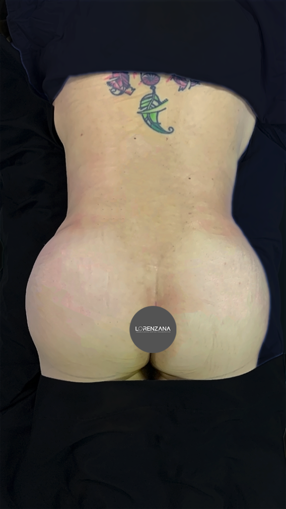 Lipoescultura