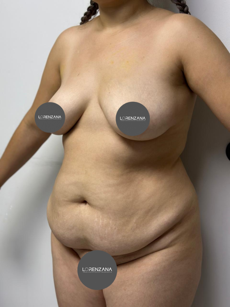 Abdominoplastia