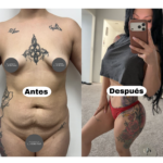 Mommy Makeover: Una transformación para tu vida