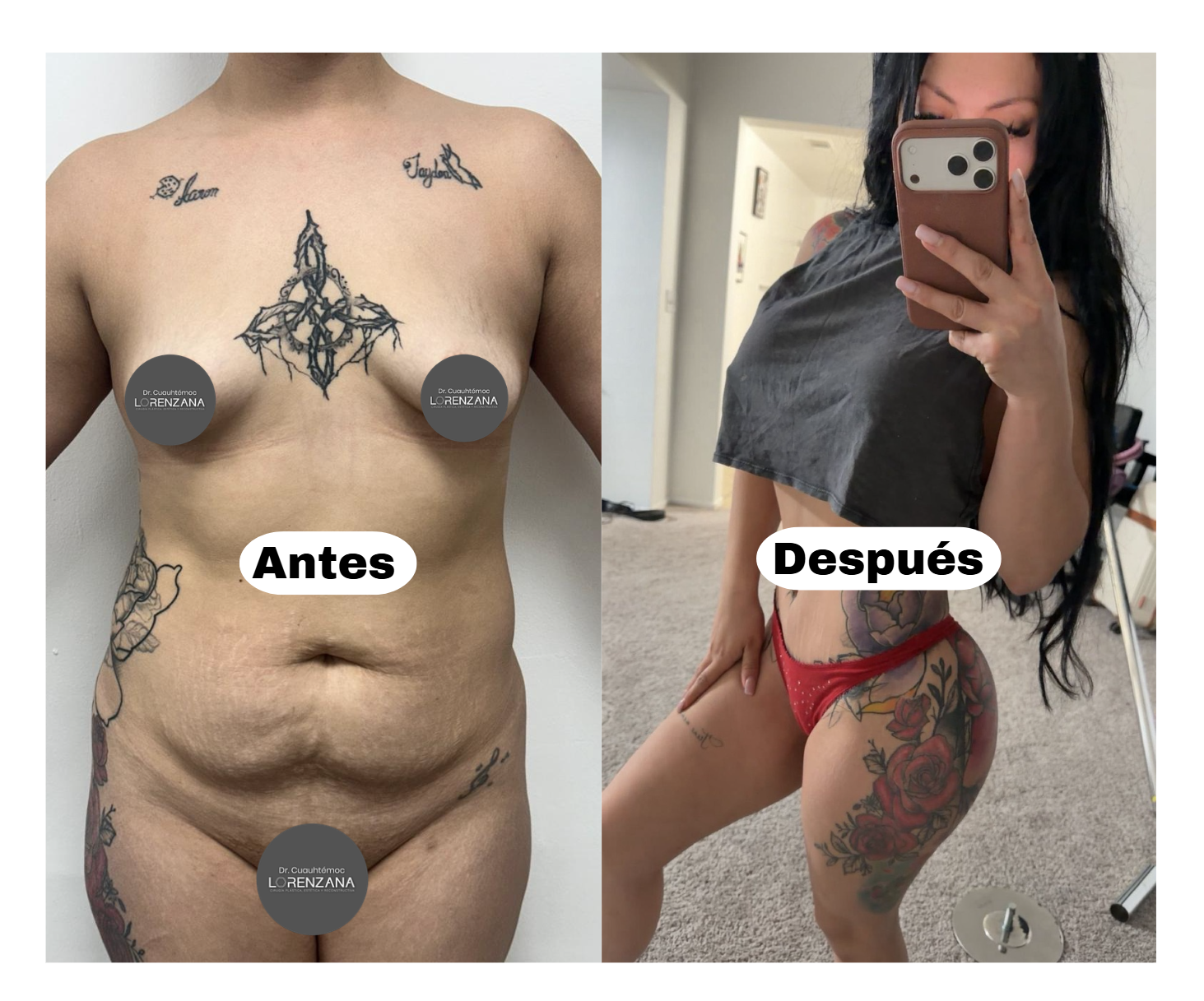Mommy Makeover: Una transformación para tu vida