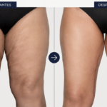 Cruroplastia: una solución para el exceso de piel y flacidez en los muslos