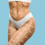 Lipoescultura: ¿cuánto tiempo duran sus resultados?