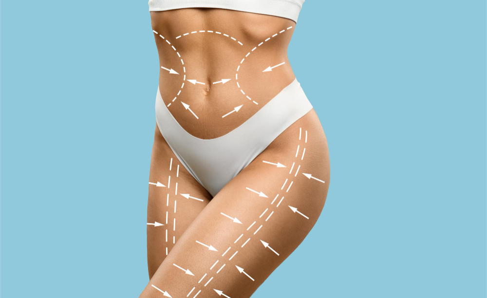 Lipoescultura: ¿cuánto tiempo duran sus resultados?