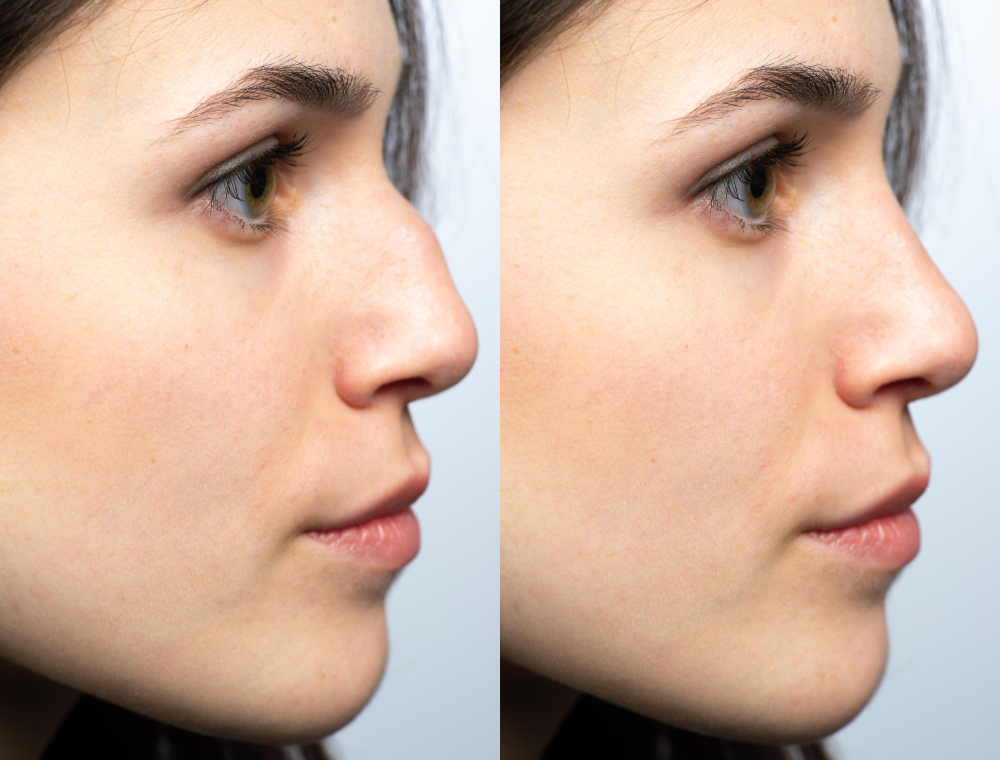 Rinoplastia funcional y estética: ¿se pueden corregir la respiración y la apariencia en una misma cirugía?