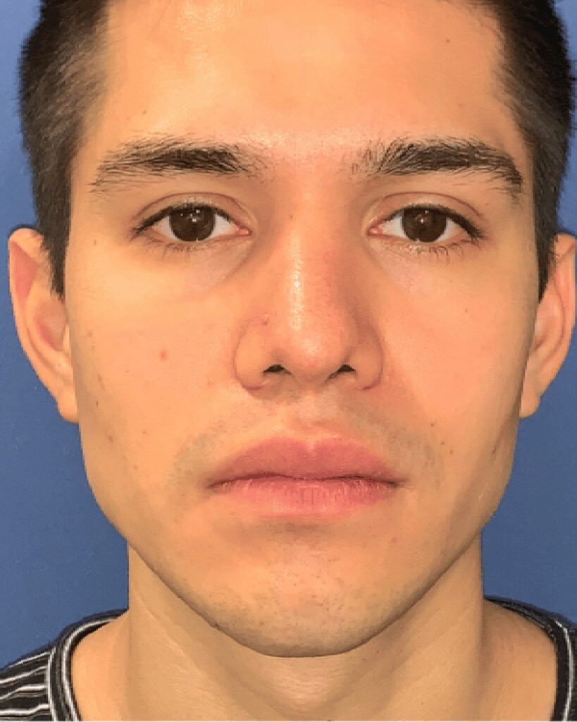 Fillers y rellenos faciales