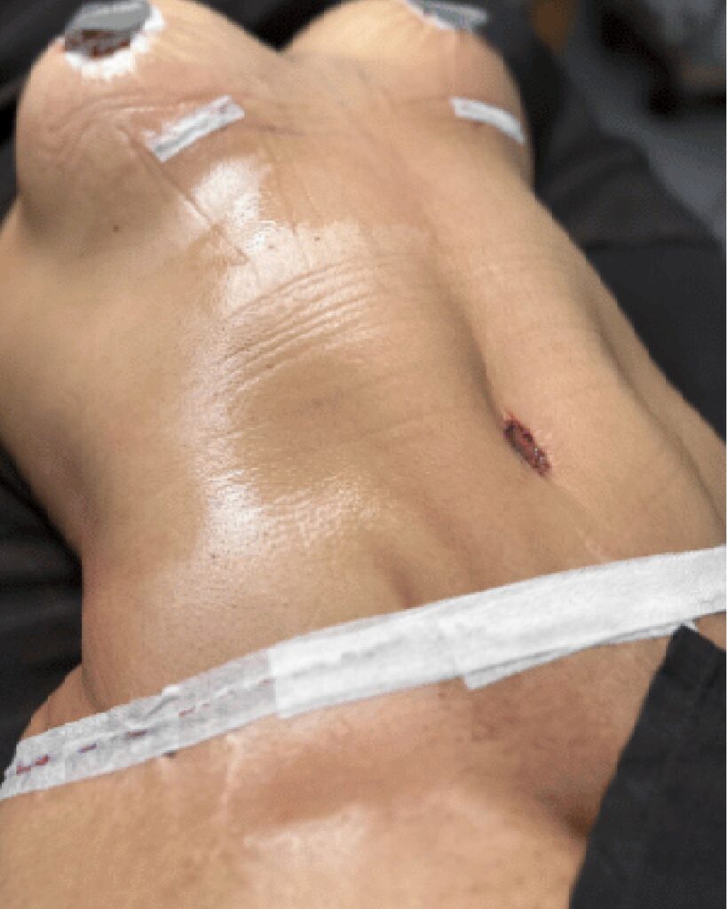 Lipoescultura y Lipotransferencia