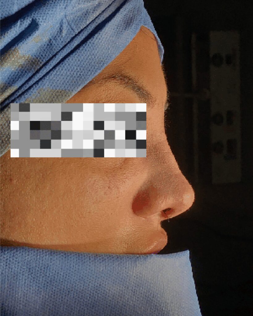 Rinoplastia